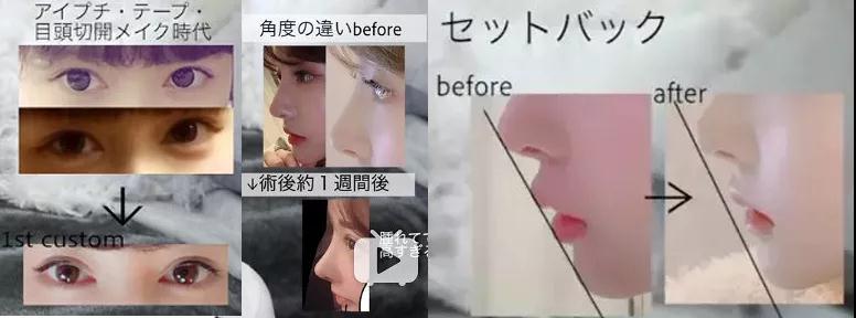 自体脂肪填充术