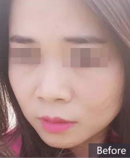 隆鼻手术