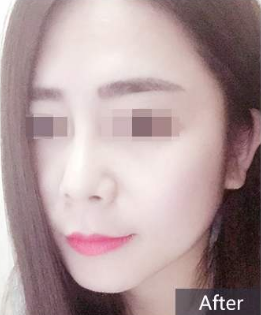 隆鼻手术