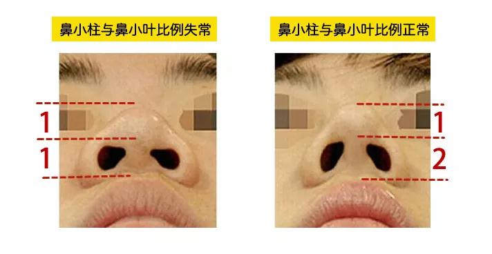 隆鼻手术