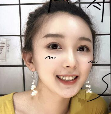 双眼皮手术