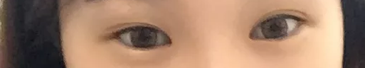 双眼皮手术