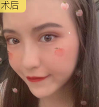 双眼皮手术