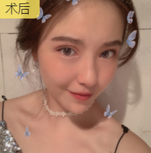 双眼皮手术