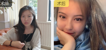 双眼皮手术