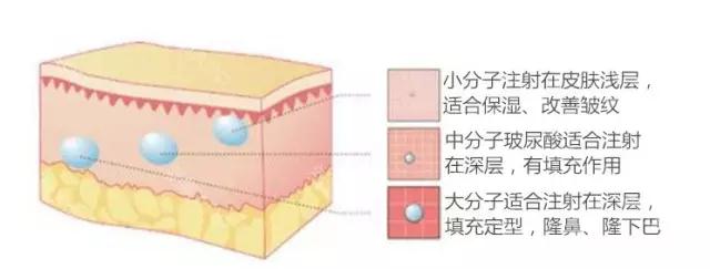 玻尿酸泪沟填充术