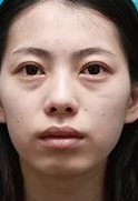 玻尿酸泪沟填充术