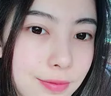 玻尿酸泪沟填充术