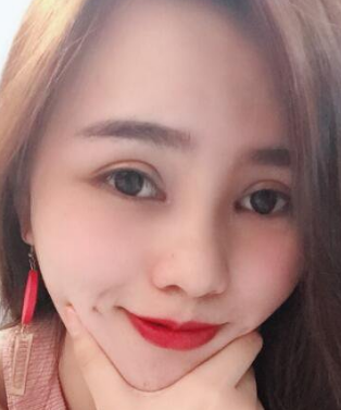 双眼皮手术