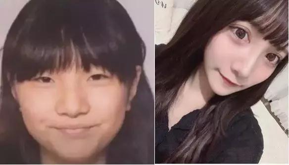 自体脂肪填充术