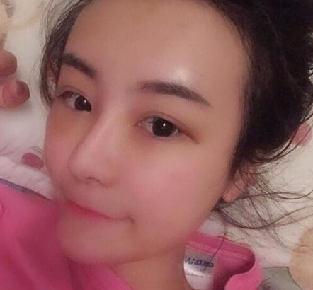 自体脂肪填充术