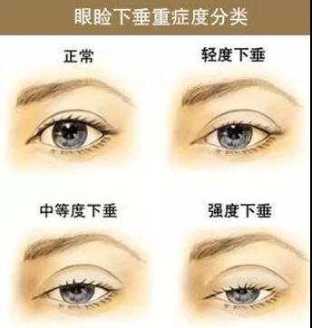 双眼皮手术