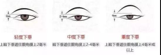 双眼皮手术