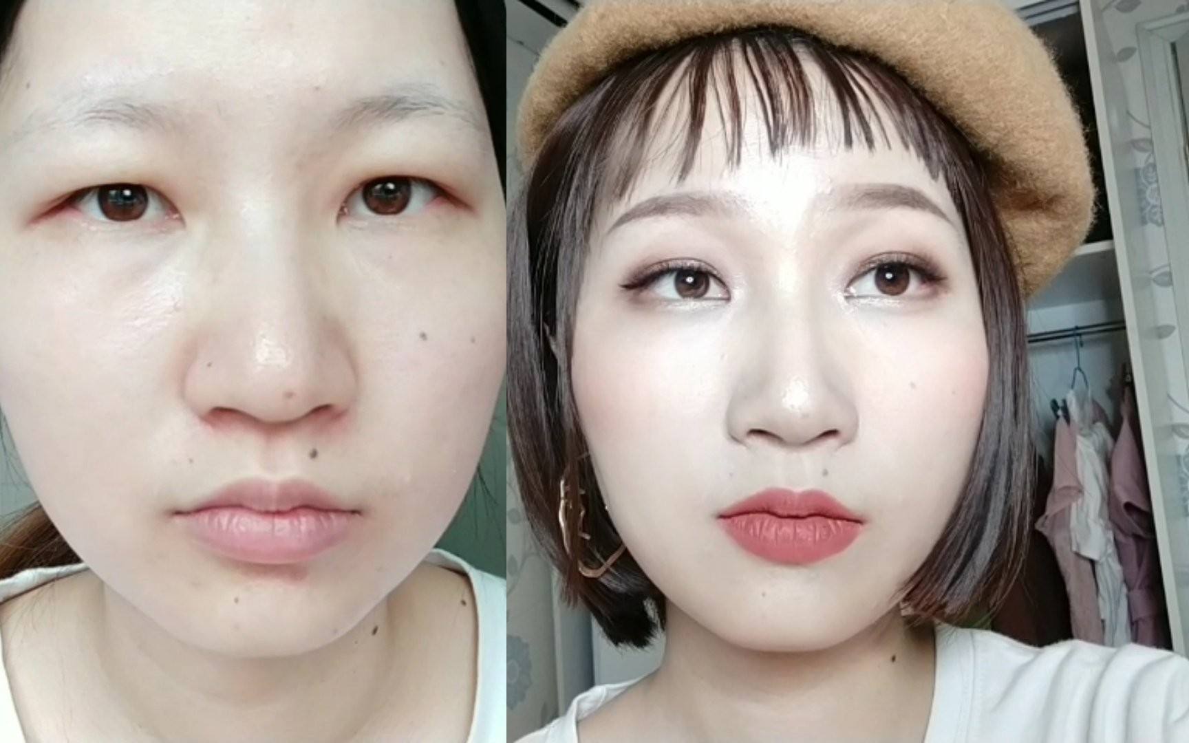 双眼皮手术