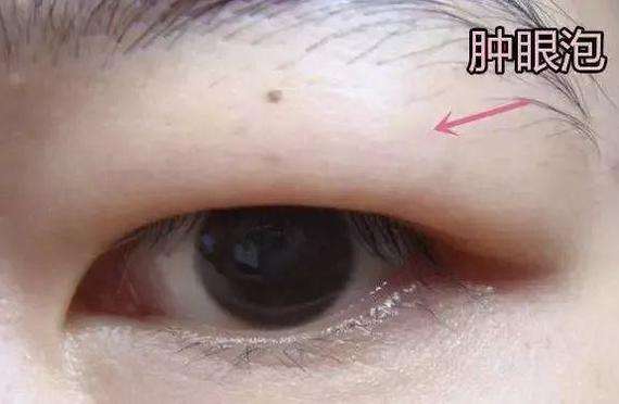 双眼皮手术