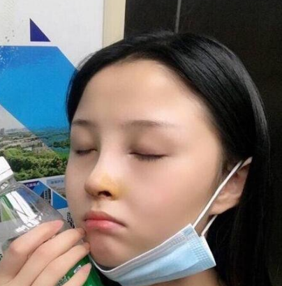 隆鼻手术