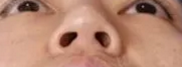 隆鼻手术