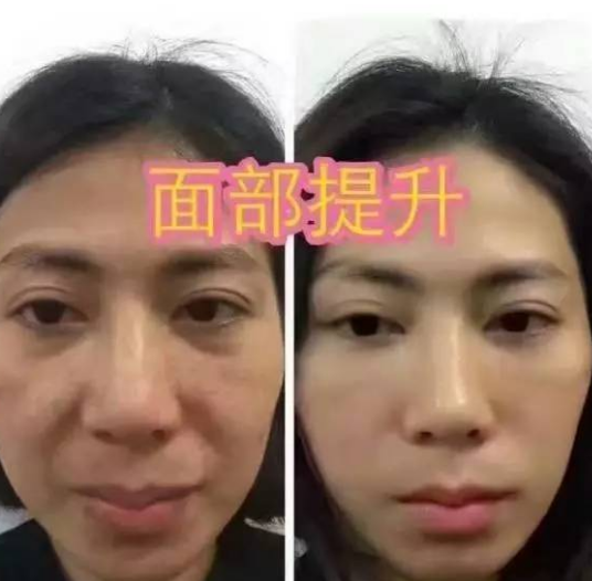 面部提升术
