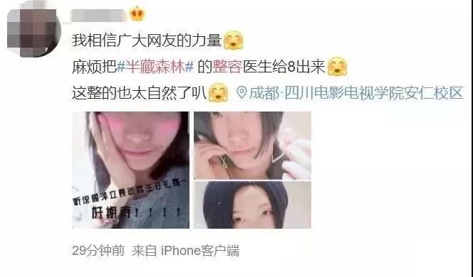 双眼皮手术