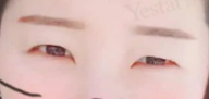 双眼皮手术
