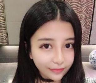 双眼皮手术