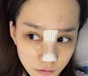 隆鼻手术