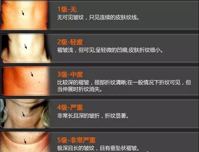面部提升术