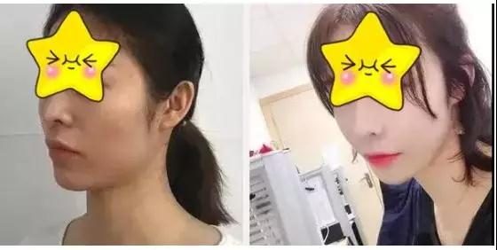 自体脂肪填充术