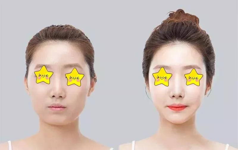 自体脂肪填充术