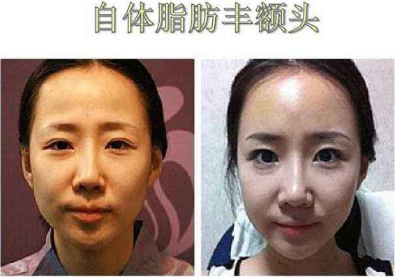 自体脂肪填充术