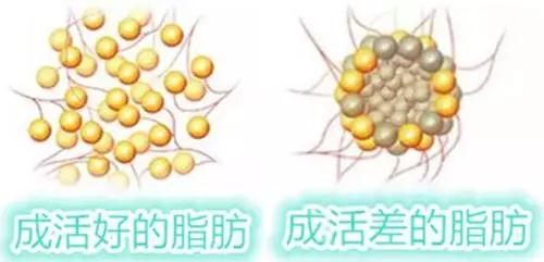 自体脂肪填充术