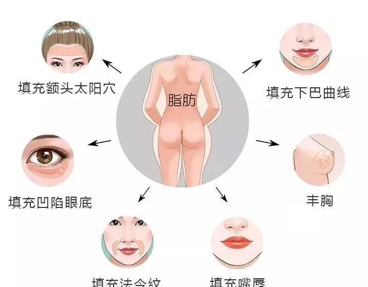 自体脂肪填充术