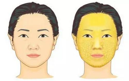 自体脂肪填充术