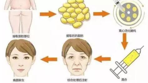 自体脂肪填充术
