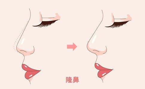 隆鼻手术