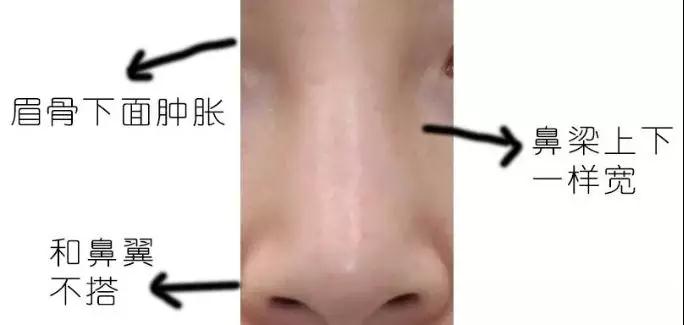 隆鼻手术