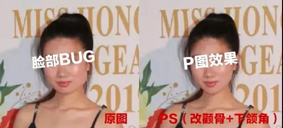 超声波瘦脸