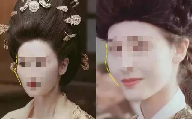 自体脂肪填充术