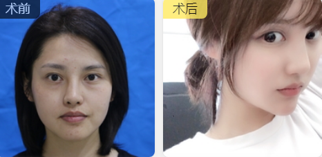 自体脂肪填充术