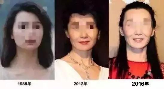自体脂肪填充术