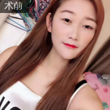 双眼皮手术