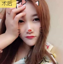 双眼皮手术