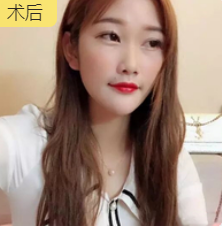 双眼皮手术