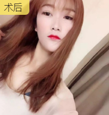 双眼皮手术