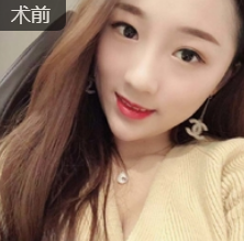 双眼皮手术