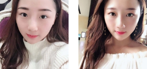 双眼皮手术