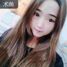 双眼皮手术
