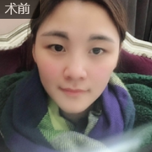 双眼皮手术