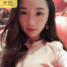 双眼皮手术