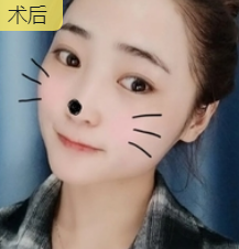 双眼皮手术